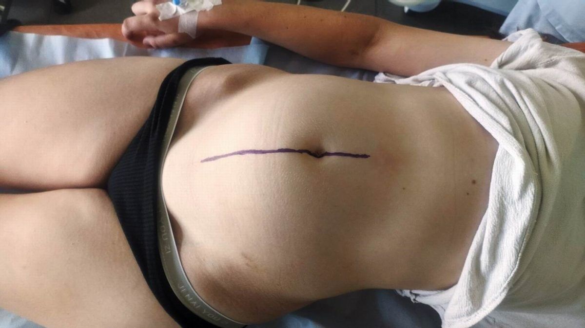 Волинські лікарі вирізали 15-річній дівчині пухлину черевної порожнини