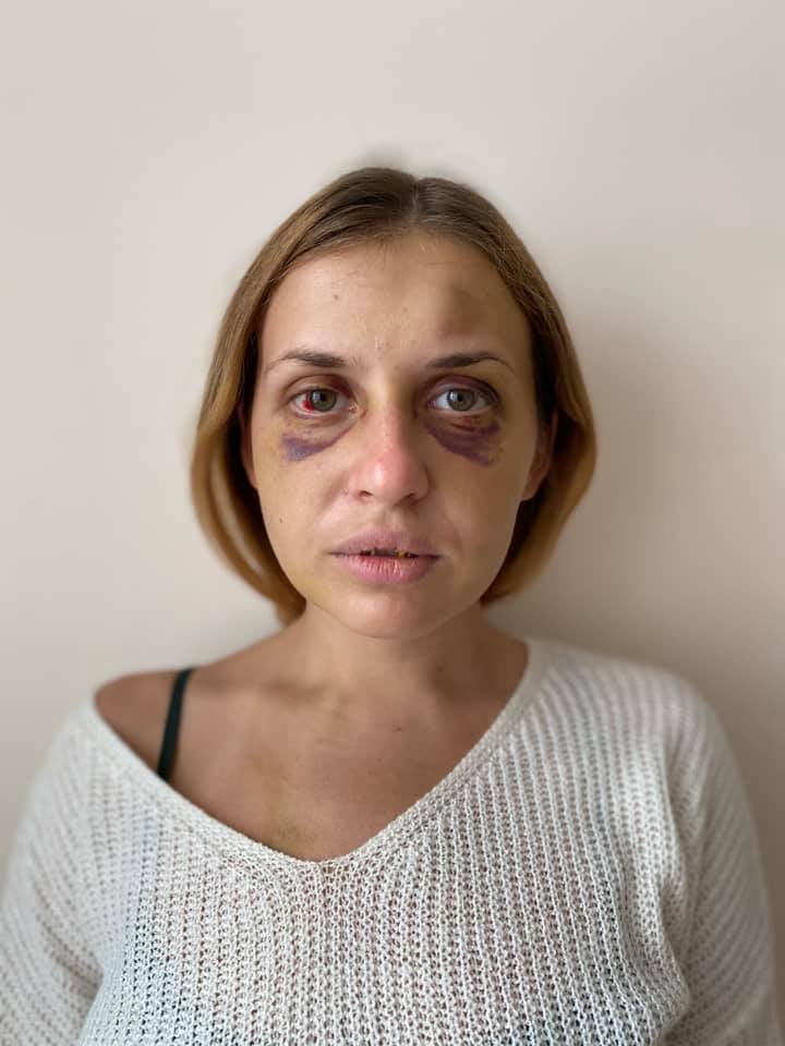 Анастасія Лугова після нападу. Фото – фейбсук Лугової