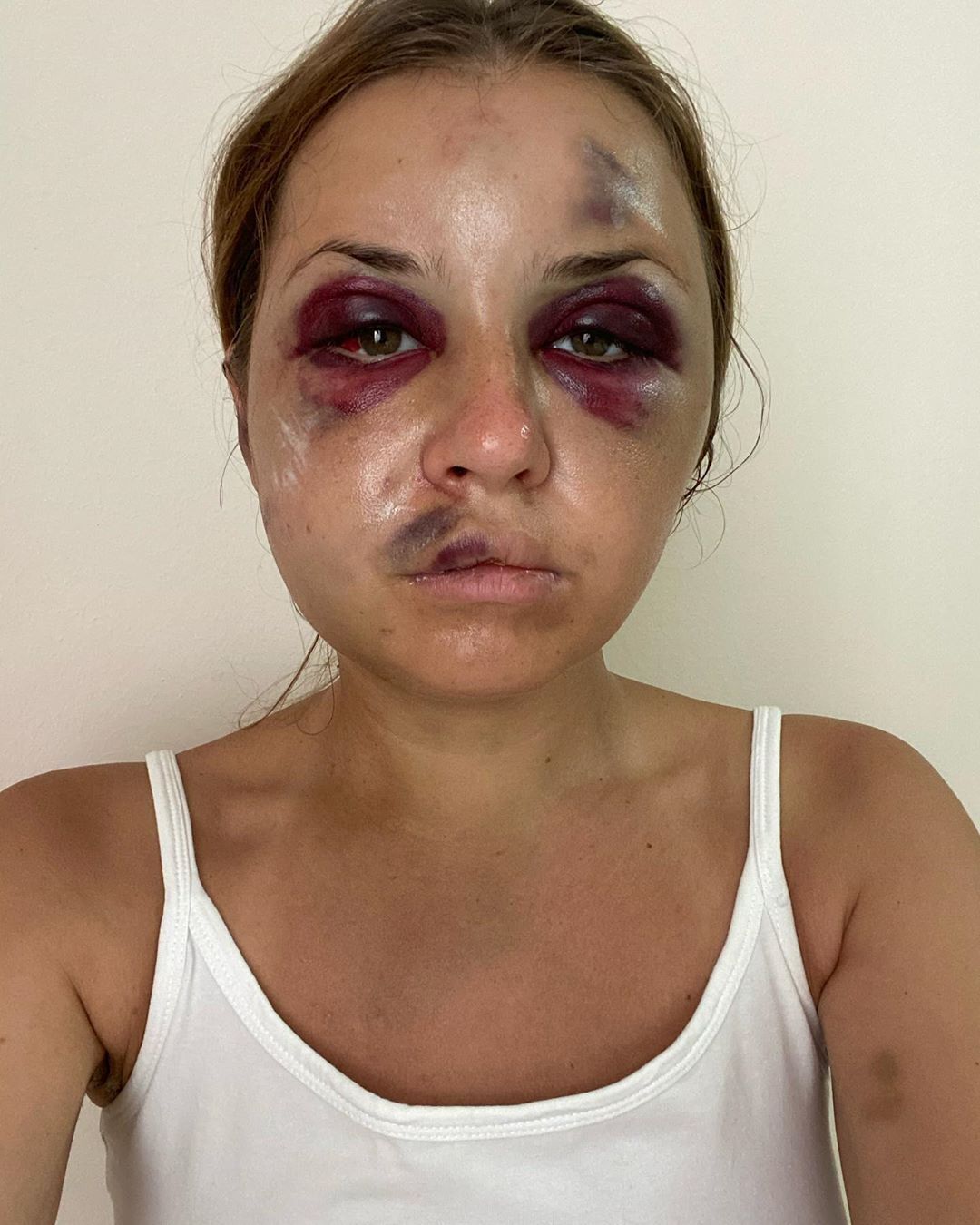 Анастасия Луговая на 2-й день после избиения