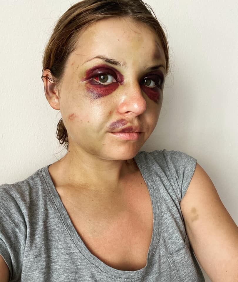 Анастасия Луговая на 3-й день после избиения
