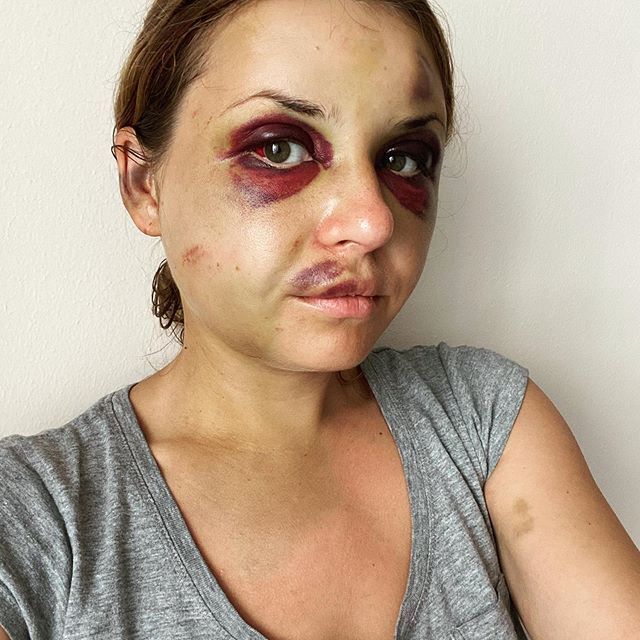 Анастасия Луговая после нападения