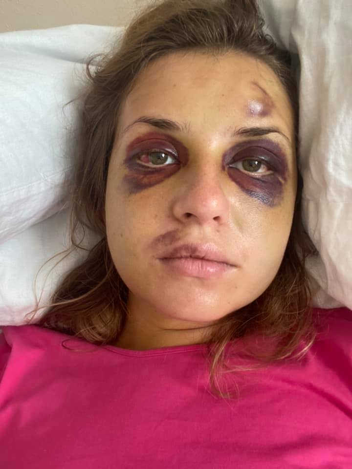Анастасія Лугова показала, як виглядає на 7-й день після нападу в поїзді