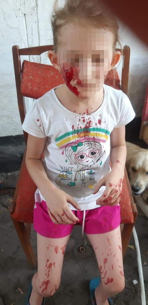 Животное укусило девочку за лицо