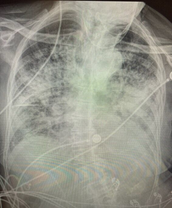 Легені пацієнта після COVID-19