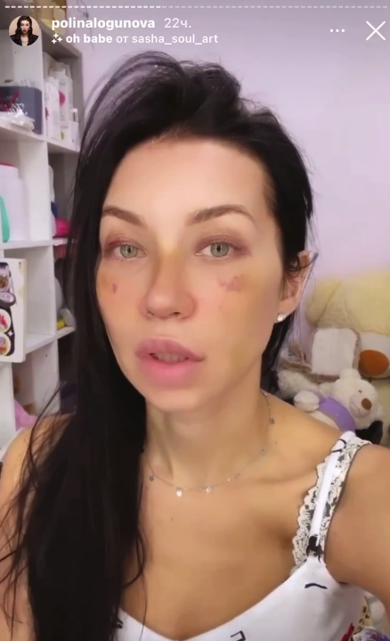 Полина Логунова после операции