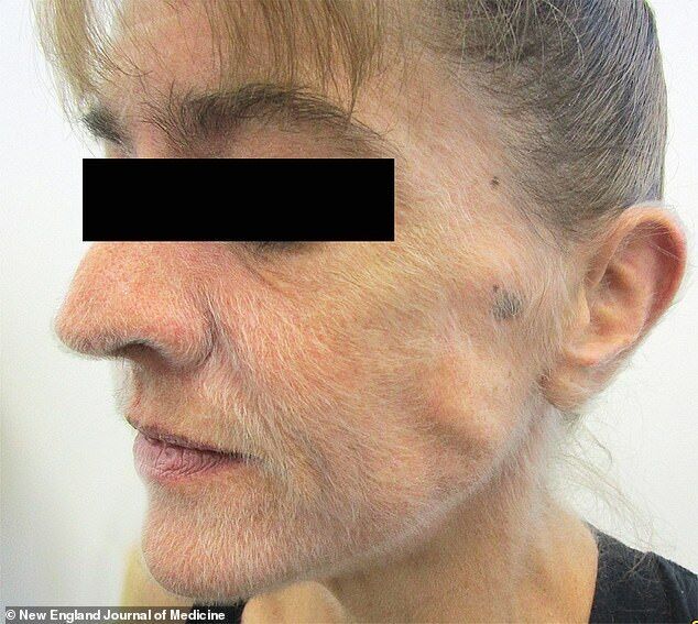 Лицо, шея и верхняя часть тела женщины покрылись тонкими волосками