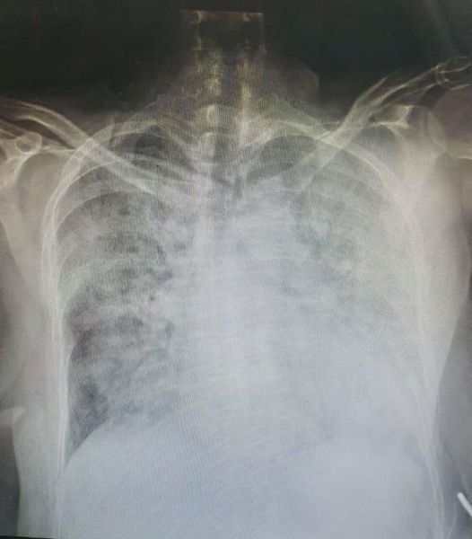 Рентген пацієнта без вакцини.