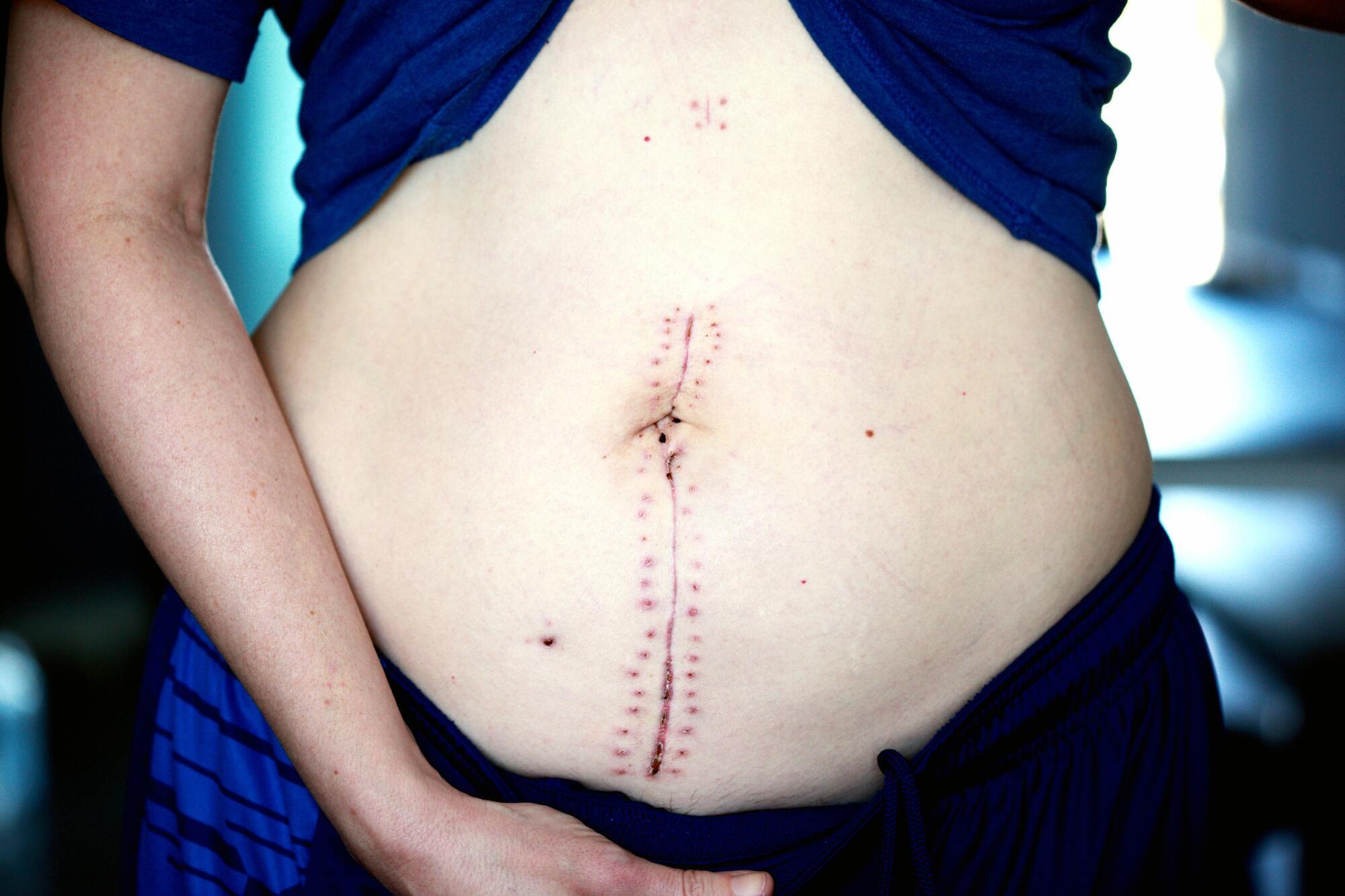 Абдоминопластику чаще всего делают женщины после родов