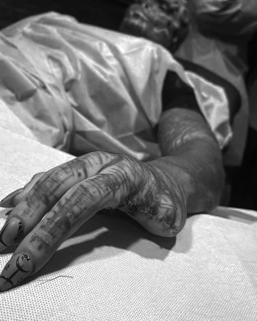 Рука після операції
