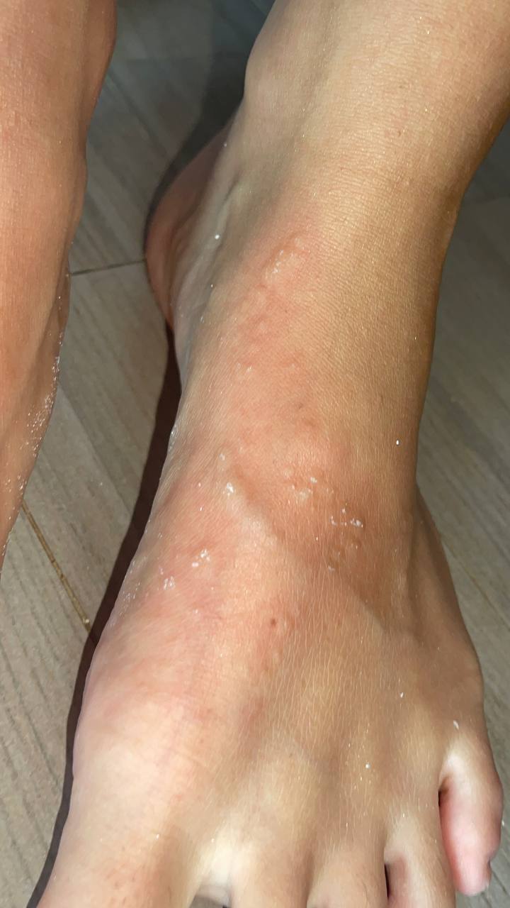 Певицу на отдыхе ужалила медуза