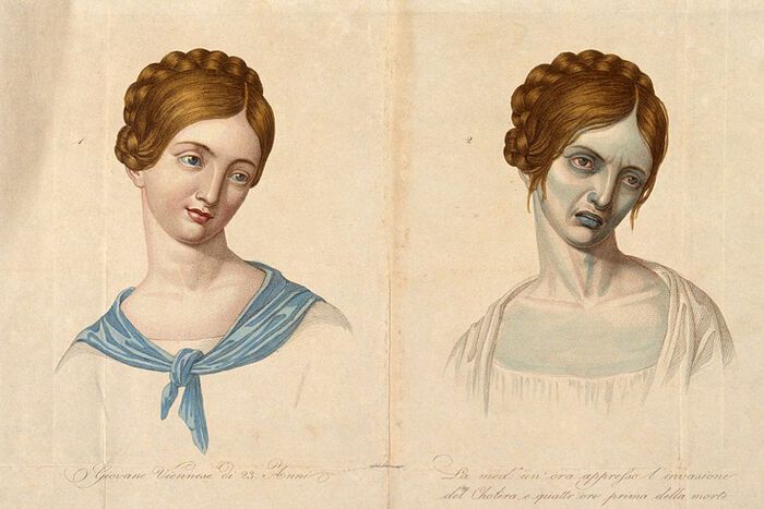 Малюнок дівчини до та після зараження холерою, Відень (Австрія), 1831 рік