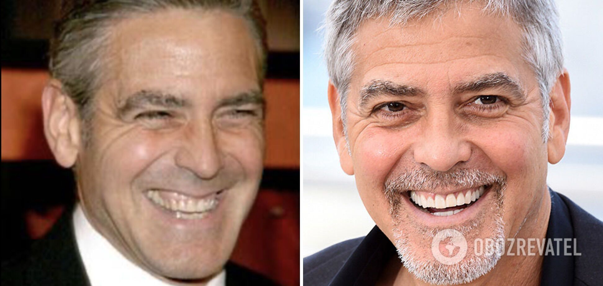 Джордж Клуни также поставил виниры.