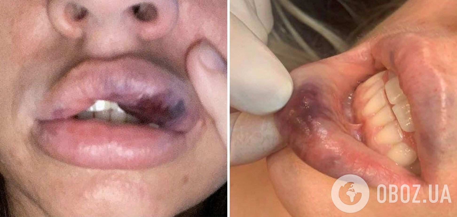 Косметолог уколола губы и попала иглой в вену.
