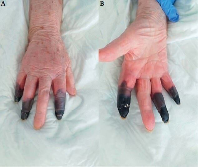 Женщине с COVID-19 ампутировали почерневшие пальцы
