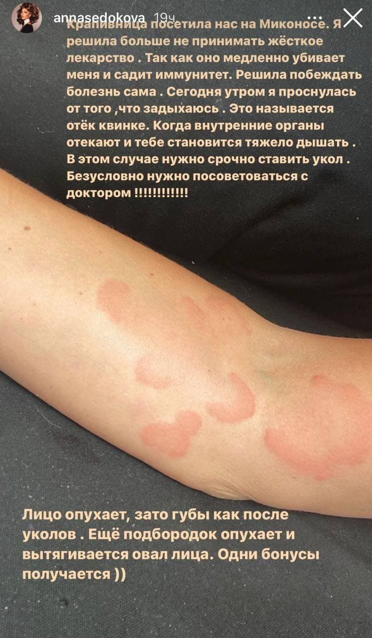 Седокова показала руки во время болезни.