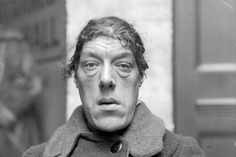 Мэри Энн Беван страдала акромегалией.