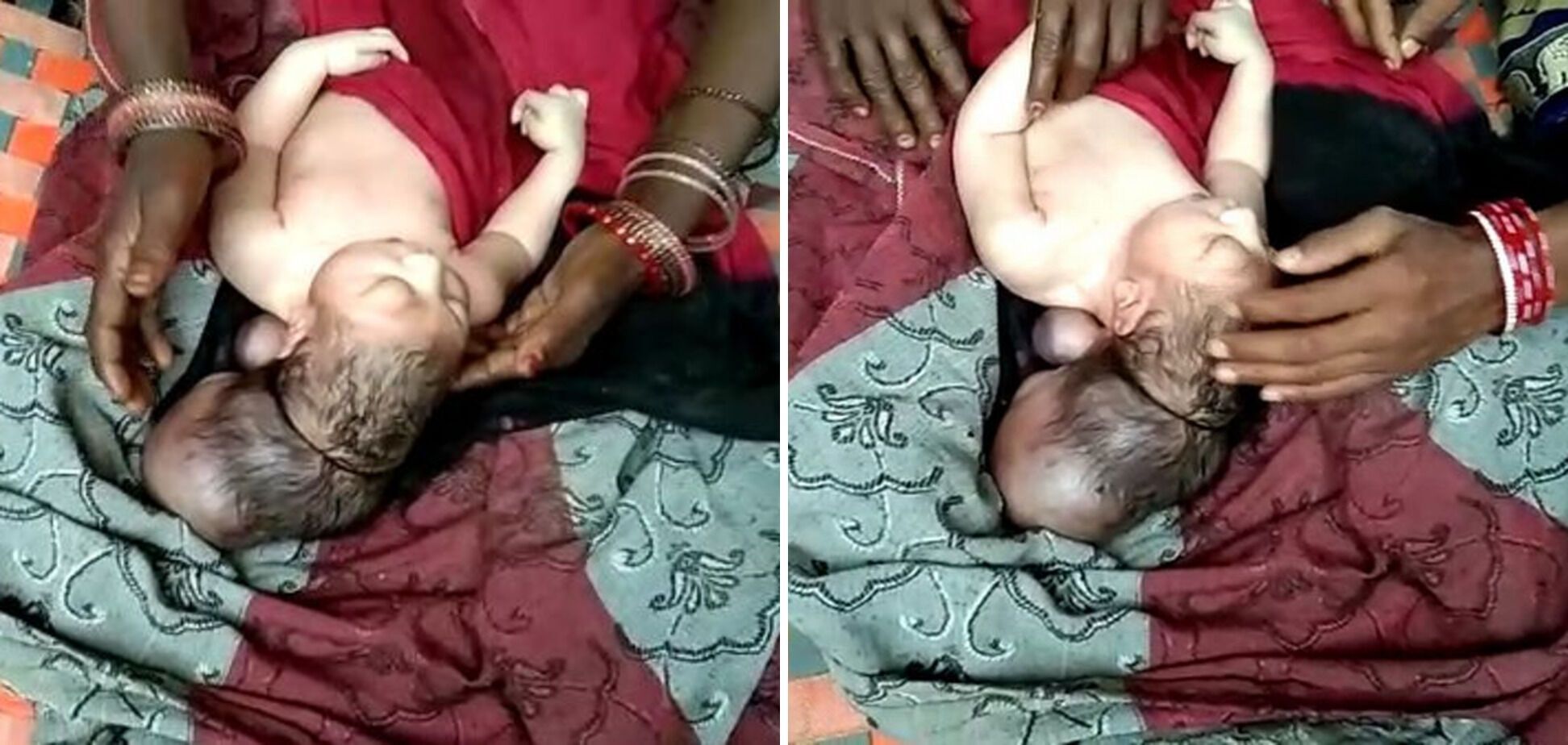 В Індії народилася дитина з трьома головами