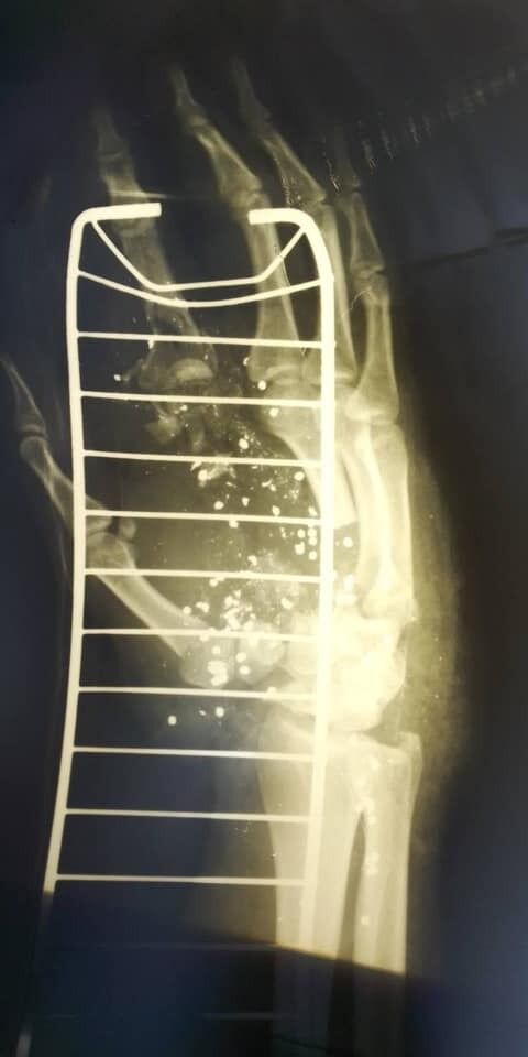 Рентгенівський знімок. На ньому видно роздроблені кістки руки патрульного