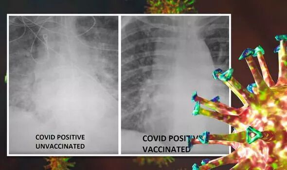 Різниця рентген-знімків вакцинованої і невакцинованої людей, інфікованих коронавірусом