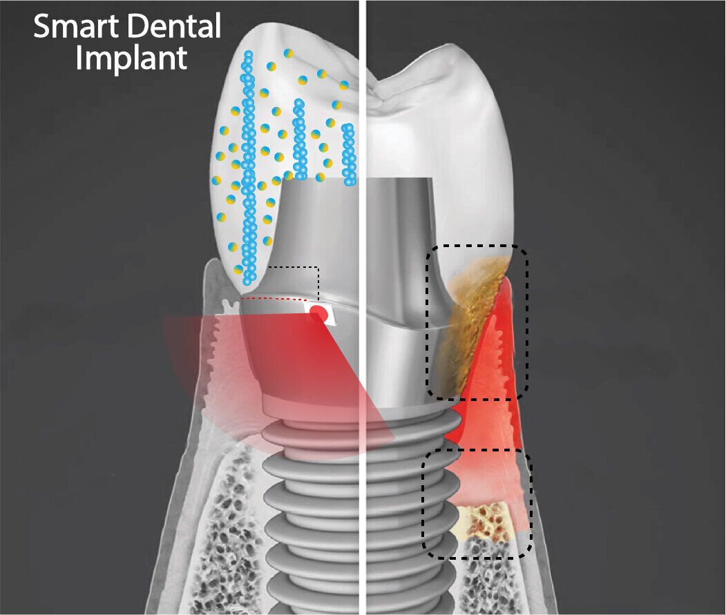 Умные зубные имплантаты: преимущества новой технологии
