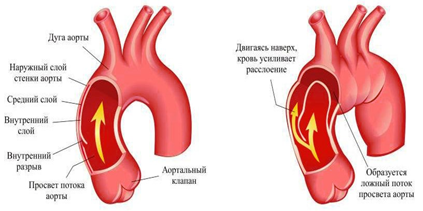 Розшаровувальна аневризма аорти