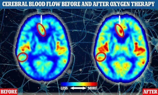 Два снимка МРТ головного мозга  показывают кровоток до (слева) и после (справа) кислородной терапии