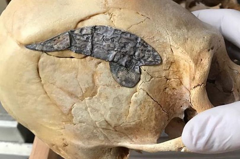 У Перу знайшли видовжений череп воїна, сплавлений із невідомим металом.