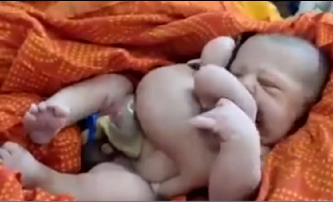 В Індії народилася дитина з вісьмома кінцівками