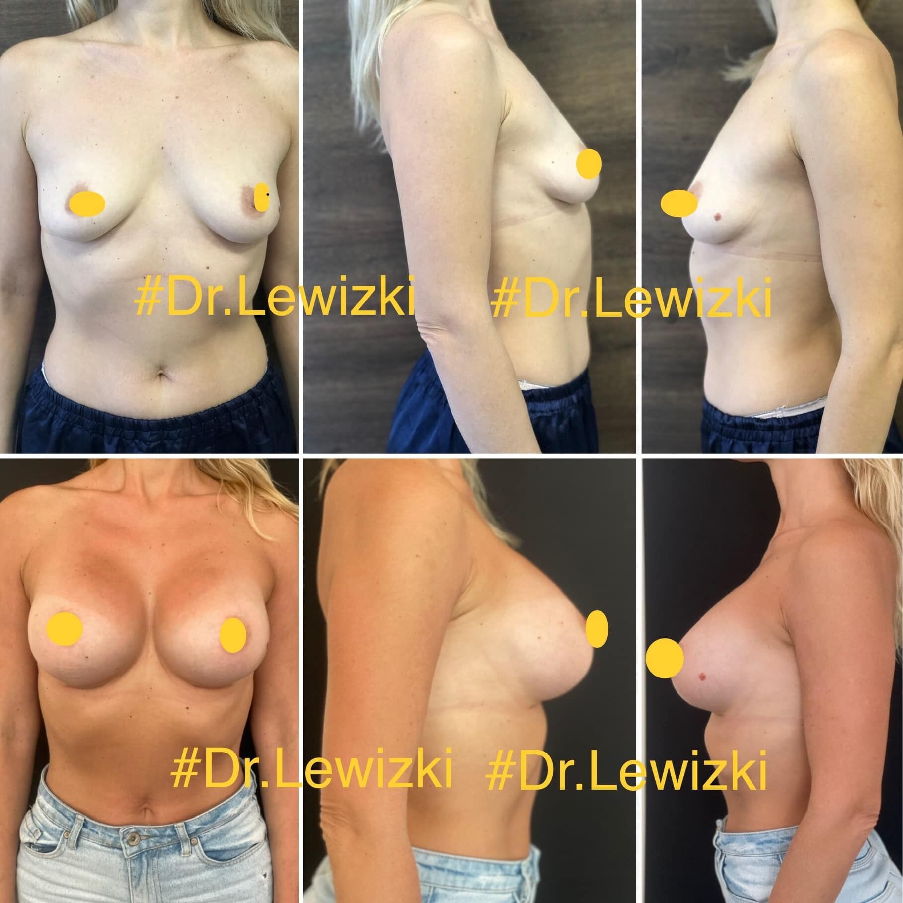 До и после операции по увеличению груди