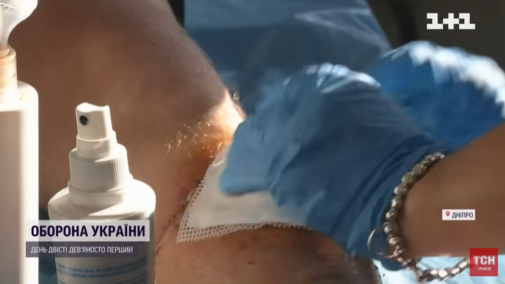 Буквально "збирають" кінцівки: медики з Дніпра рятують воїнів ЗСУ від ампутацій. Відео