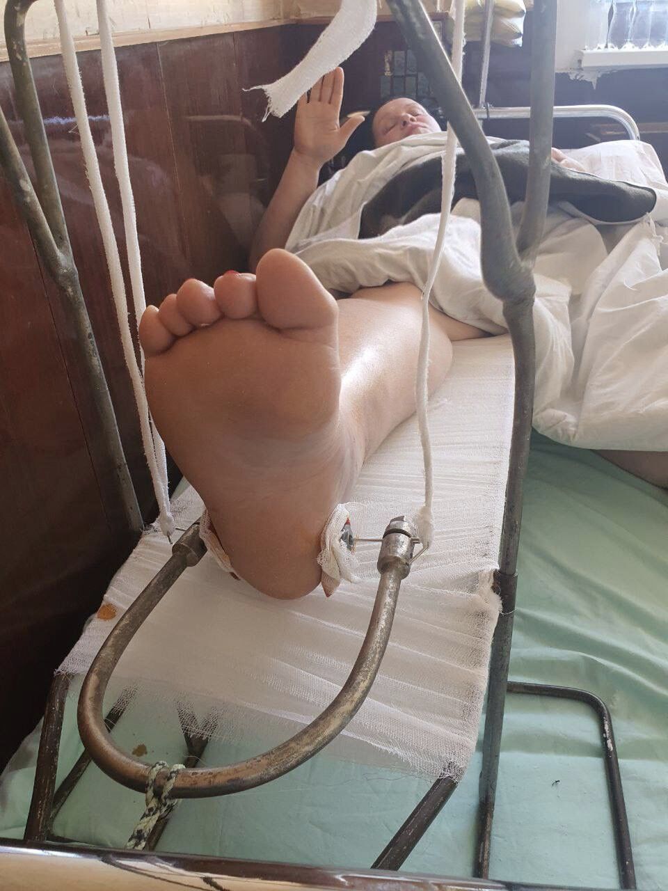 За словами артистки, ходити вона зможе через три місяці