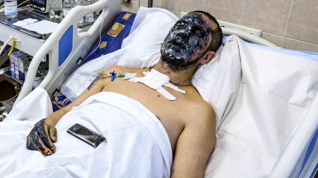 Украинский десантник получил тяжелейшие ранения, но чудом выжил