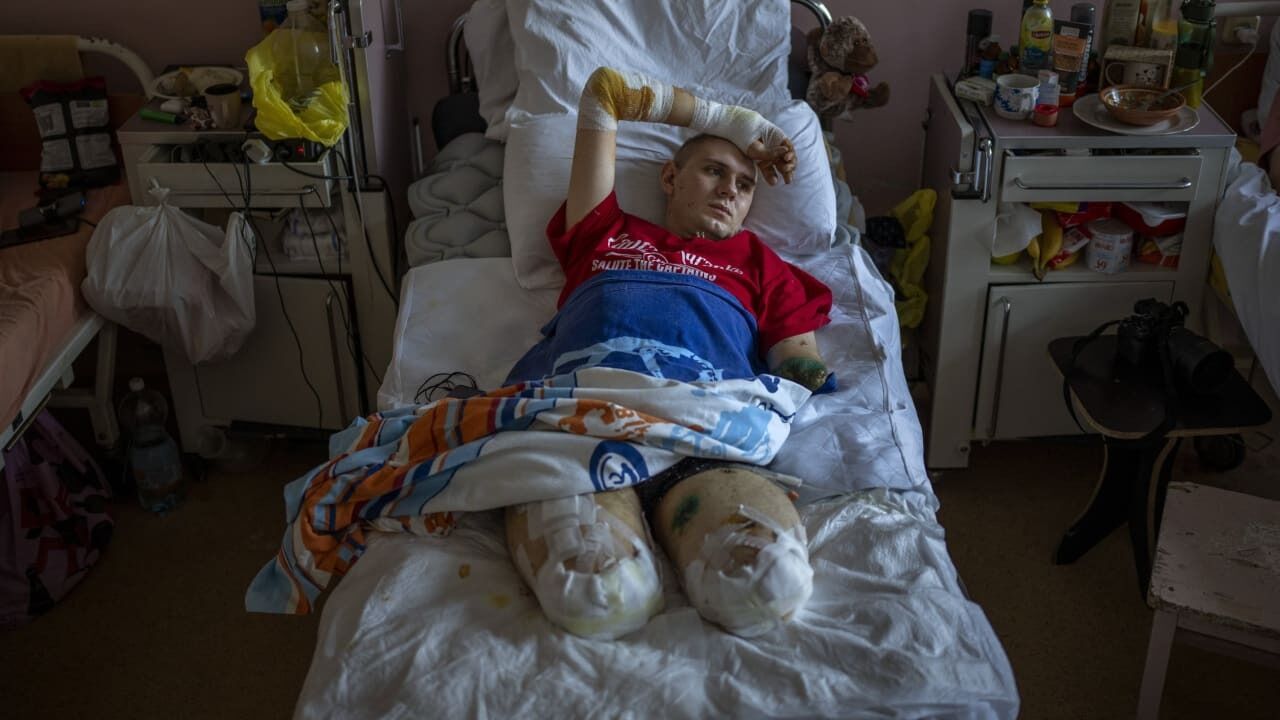 Антон пострадал от взрыва кассетной бомбы во время боев на востоке Украины