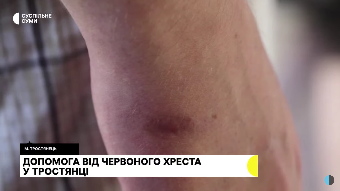 ''Натягли мішок на голову, встромили ножа в ногу'': українець розповів про перебування в полоні окупантів. Фото і відео 