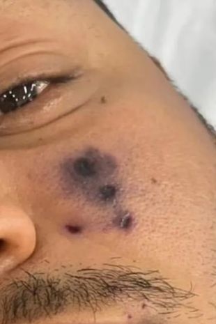 У Бразилії помер 28-річний співак: його за обличчя вкусив павук. Фото