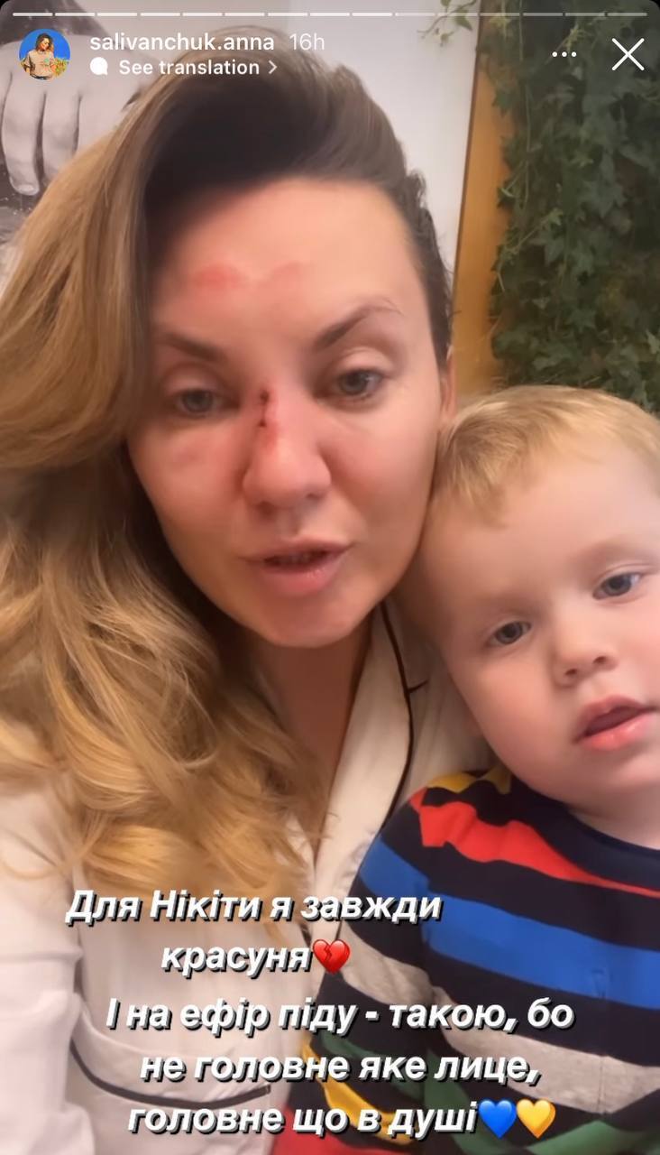 "Поскользнулась и перелом": Саливанчук заставила фанов понервничать, показав изуродованное лицо