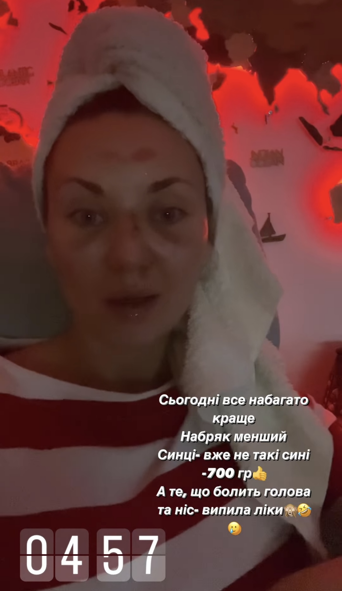 Саливанчук после травмы лица появилась на ТВ и поделились подробностями своего падения: у меня сотрясение мозга и смещение