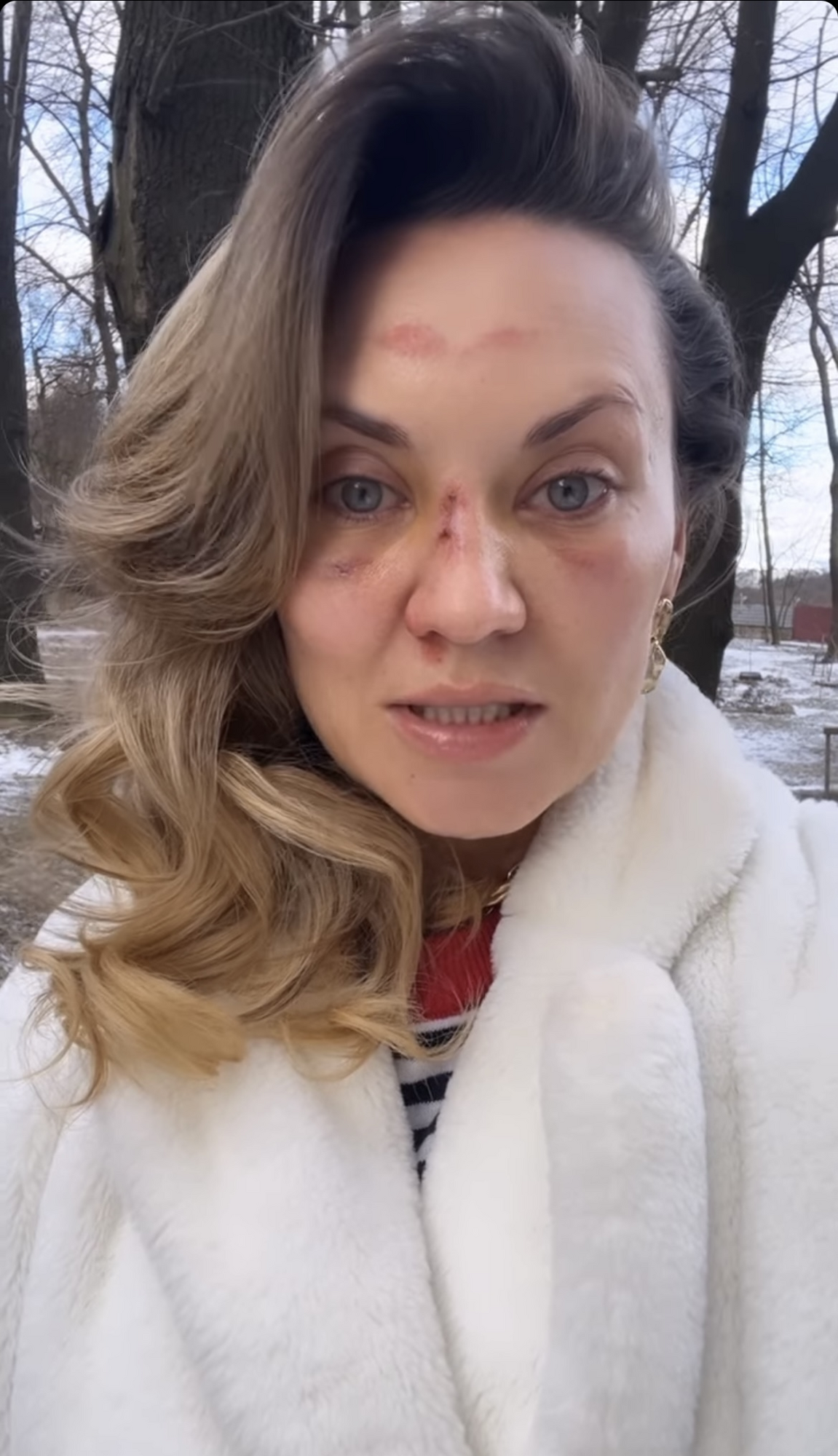 Саліванчук після травми обличчя з'явилася на ТБ та поділилися подробицями свого падіння: у мене струс мозку і зміщення