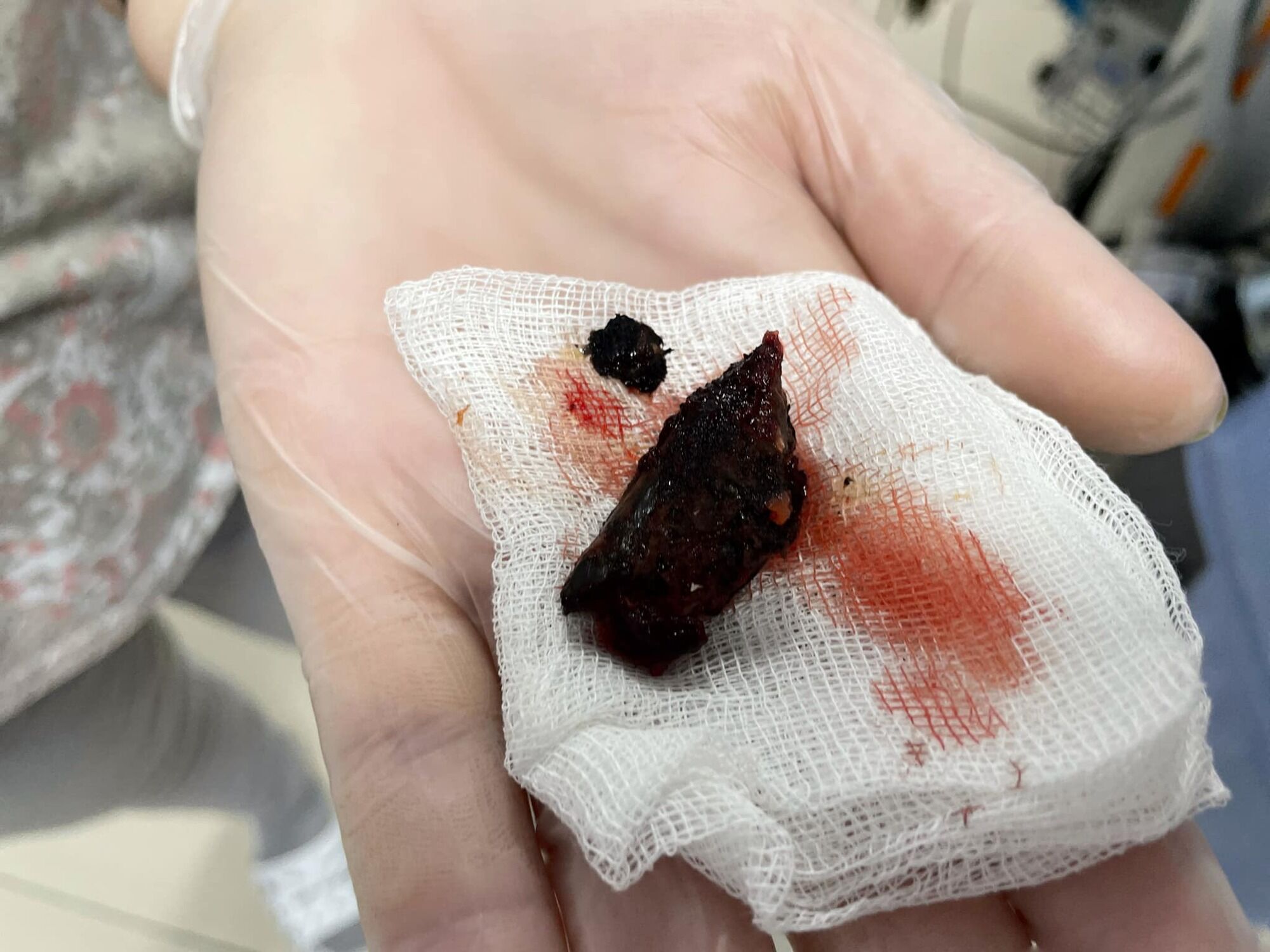 ''Родился в рубашке'': украинские медики спасли подростка, у которого осколок снаряда застрял возле сердца. Фото