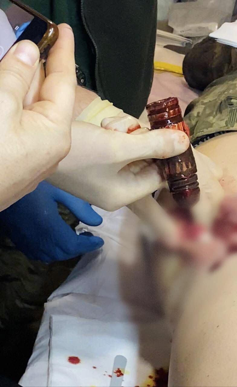 Военные медики извлекли часть гранаты из тела украинского раненого бойца: фото
