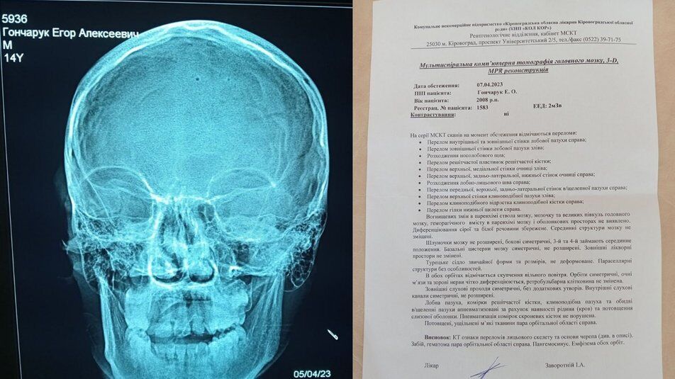 Получил переломы костей черепа: на Кировоградщине на 14-летнего школьника упали качели, ребенок попал в больницу. Фото