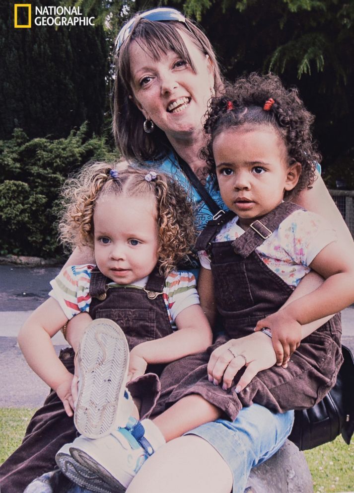 "Один случай на миллион": как сложилась судьба близняшек с разным цветом кожи, фото которых облетели мир