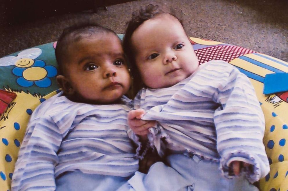 "Один випадок на мільйон": як склалася доля близнючок із різним кольором шкіри, фото яких облетіли світ