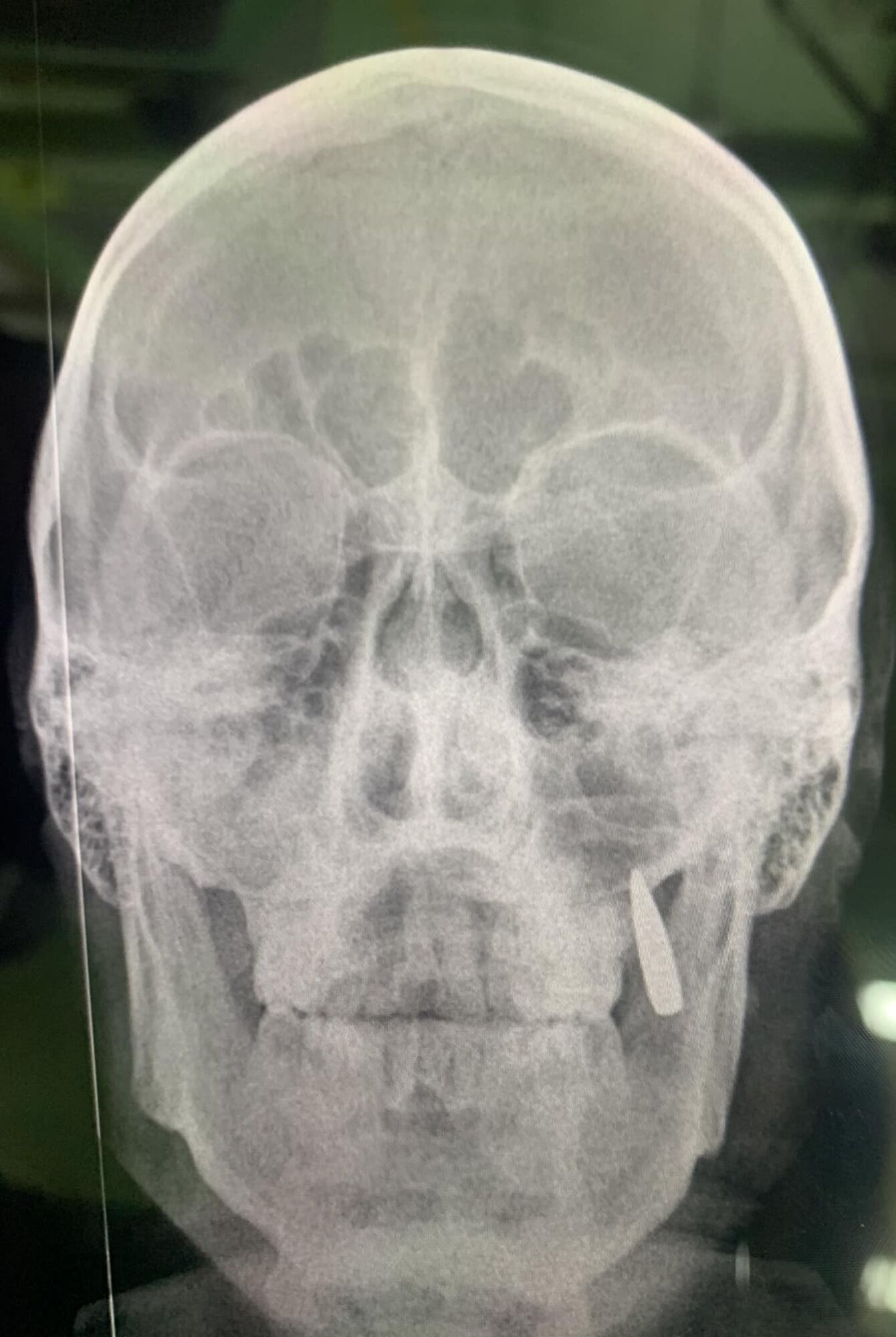 У воина ВСУ в челюсти застряла пуля: он узнал об этом только после рентгена