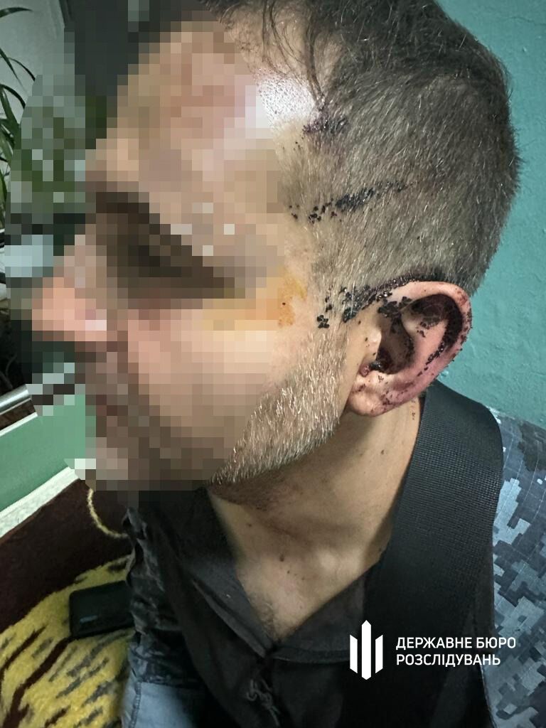 На Одещині у військовій частині побили бійця, чоловік потрапив до лікарні: справою зайнялося ДБР. Фото 