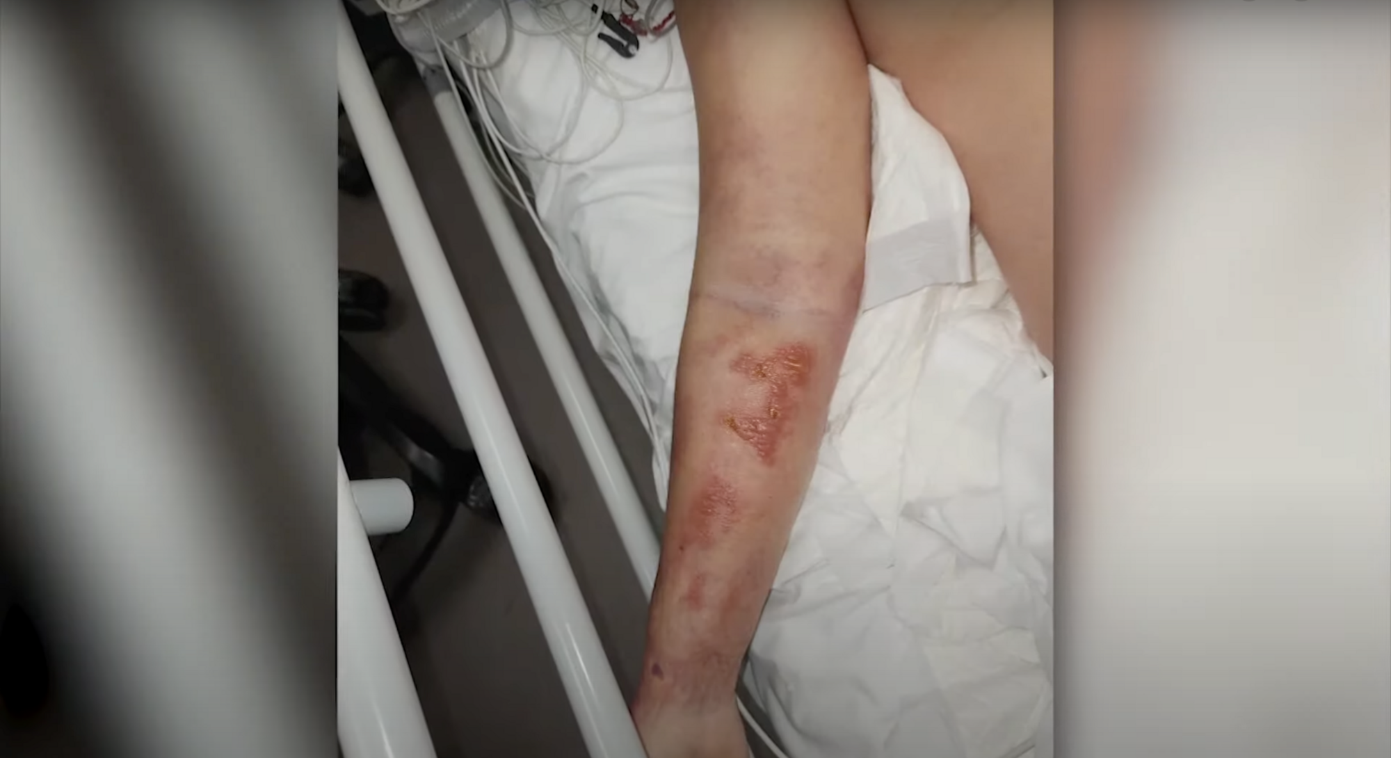 Екатерина Тышкевич впервые показала руку, которую заразили в психбольнице стафилококком, и объяснила, почему не будет подавать в суд