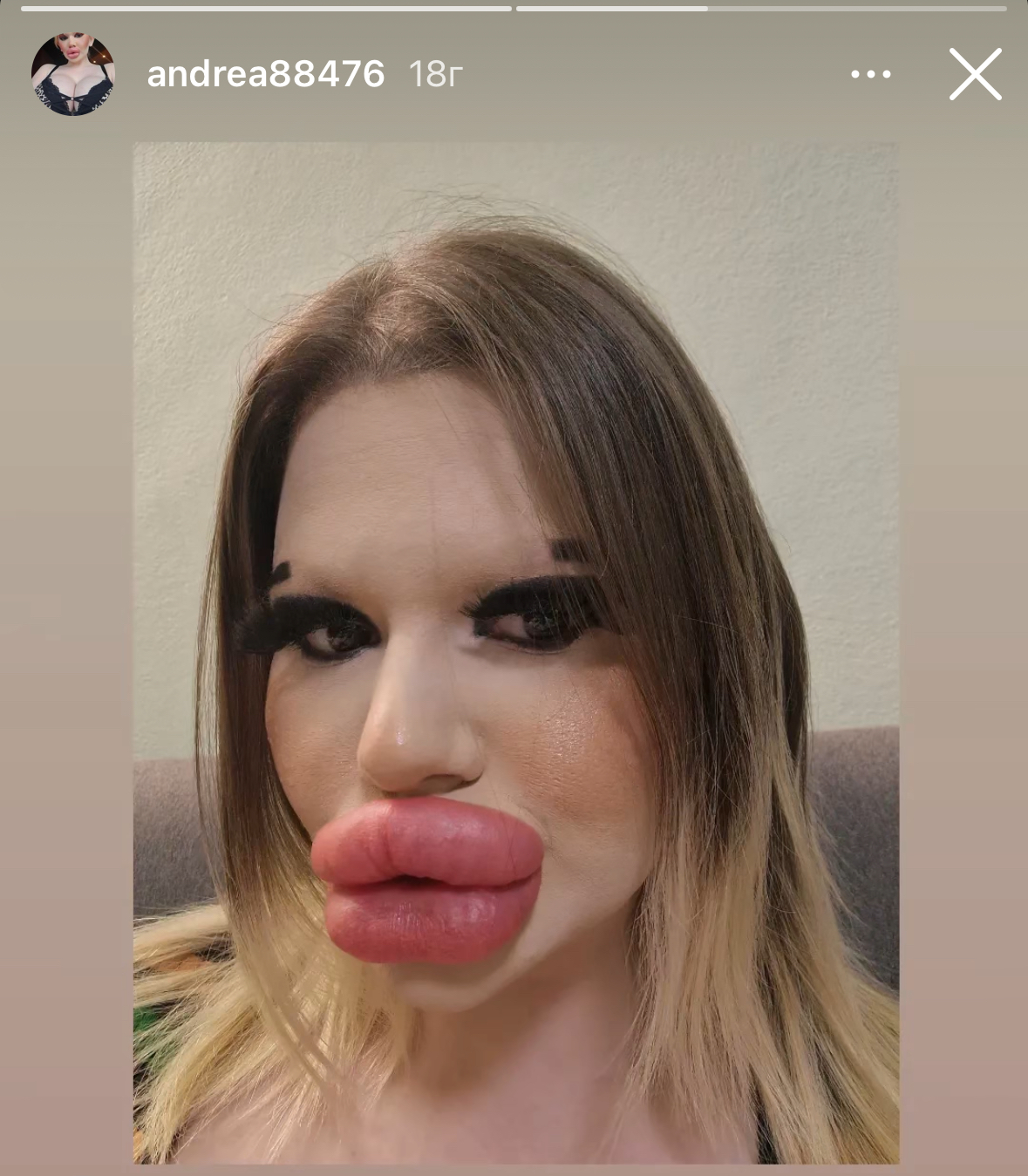 Женщина с самыми большими губами в мире сделала 6 "уколов красоты" за один день, хотя врачи предупреждали, что ее тело начнет гнить. Фото