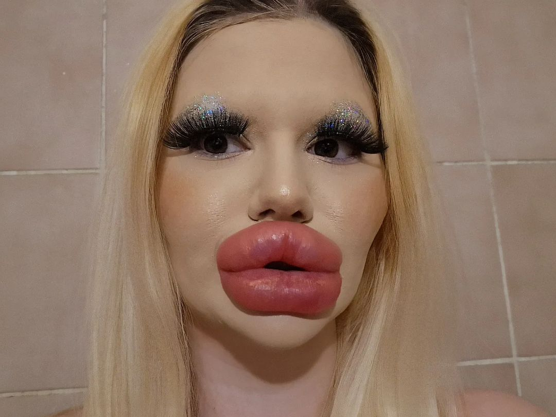 Жінка з найбільшими губами в світі зробила 6 "уколів краси" за один день, хоча лікарі попереджували, що її тіло почне гнити. Фото