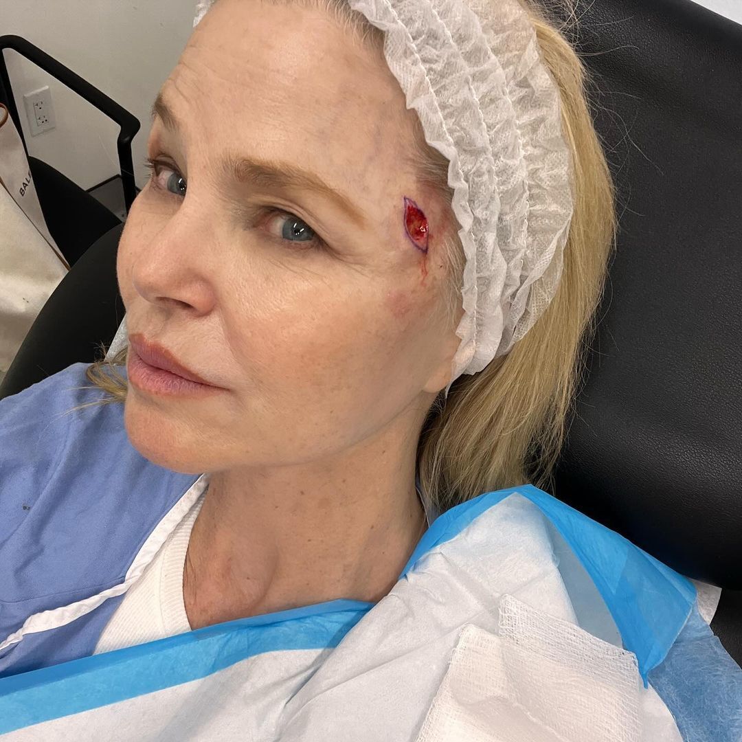 У Кристи Бринкли обнаружили рак кожи: 70-летняя супермодель показала первые фото после операции