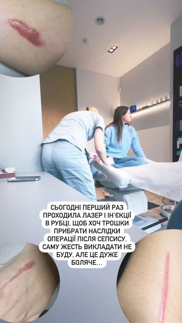 Катерина Тишкевич, яка кілька днів провела в реанімації, показала наслідки сепсису: тіло в страшних рубцях